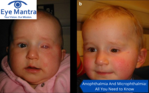 Anophthalmia And Microphthalmia
