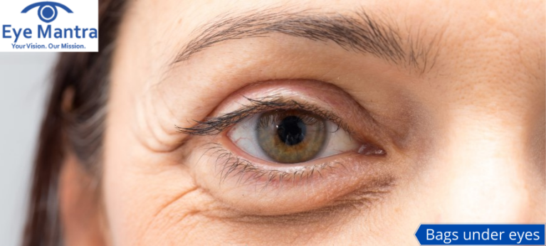 How to Get Rid of Bags Under the Eyes - American Academy of Ophthalmology