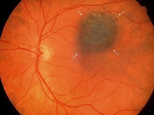 Choroidal Nevus