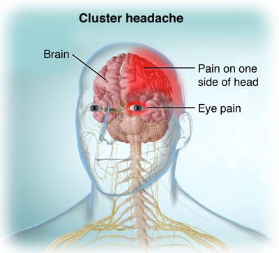 Cluster Headache due to pupil of eye