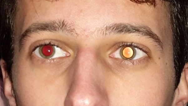 Examples of the variability of the red eye phenomenon. Golden eyes