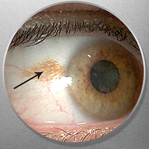 Conjunctiva Nevus