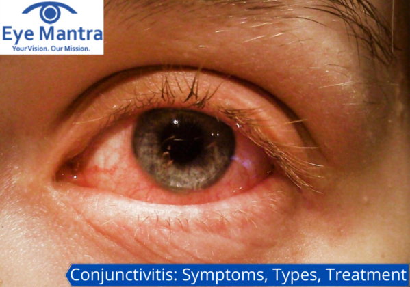 Conjunctivitis