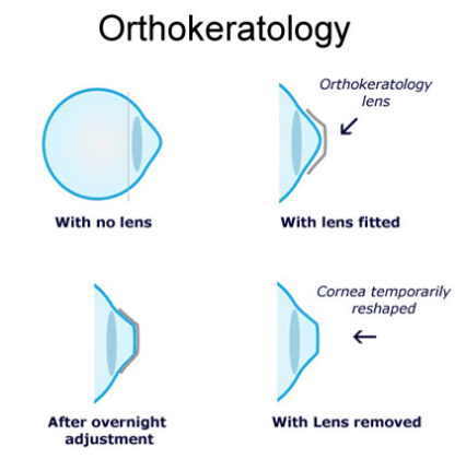 Corneal refractive therapy