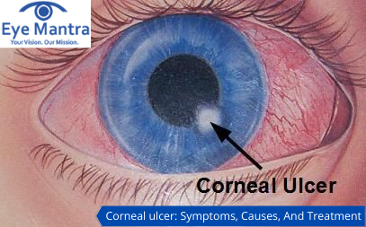 Corneal ulcer Treatment