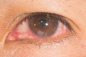 Corneal ulcer