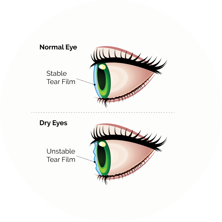 Dry Eye disorders