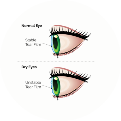 Dry Eye disorders