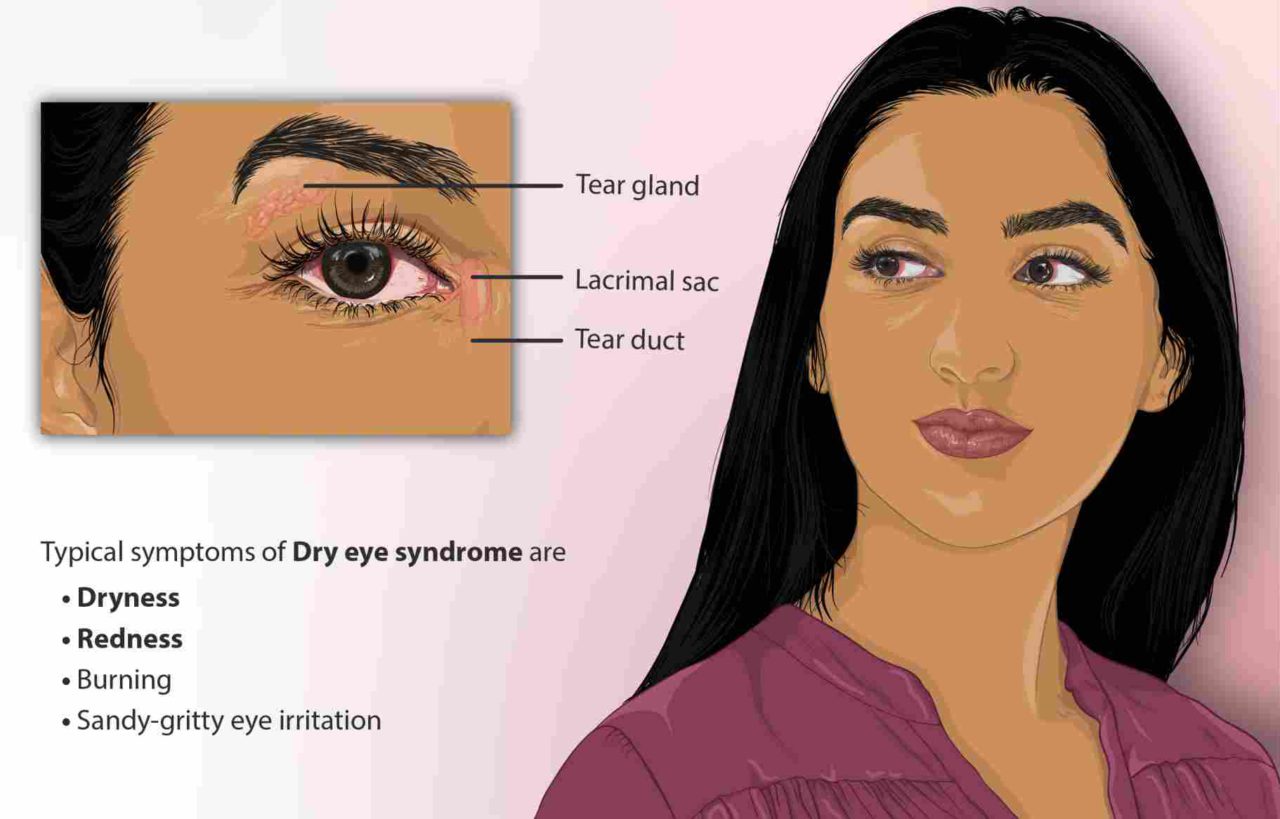 Burning Eyes Causes, Treatment And Home Remedies