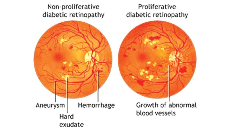 Early diabetic retinopathy