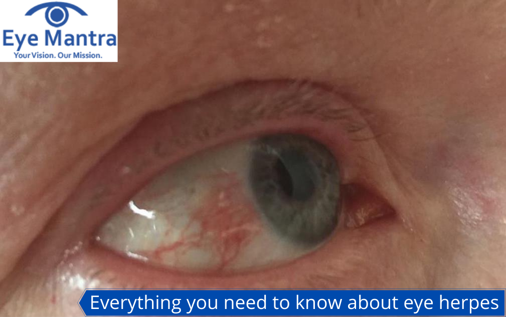 Everything you need to know about eye herpes