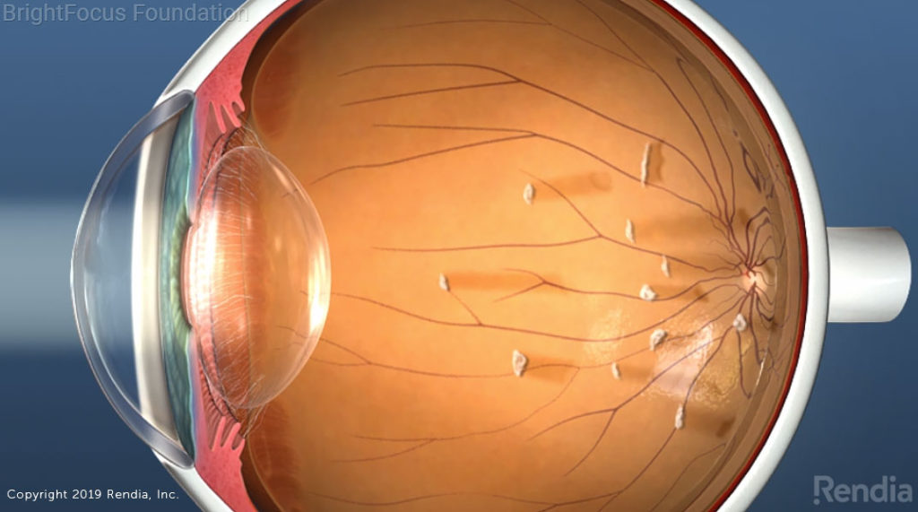 Eye Floaters-eye disorders