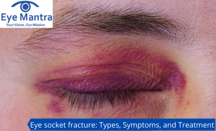 Eye socket fracture