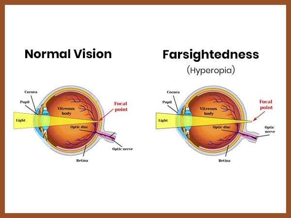 Farsightedness (Hypermetropia)