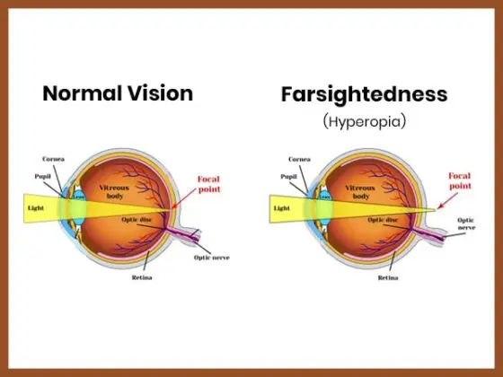 Farsightedness (Hypermetropia)