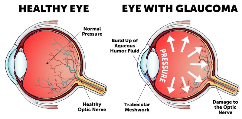 Glaucoma- eye disorders