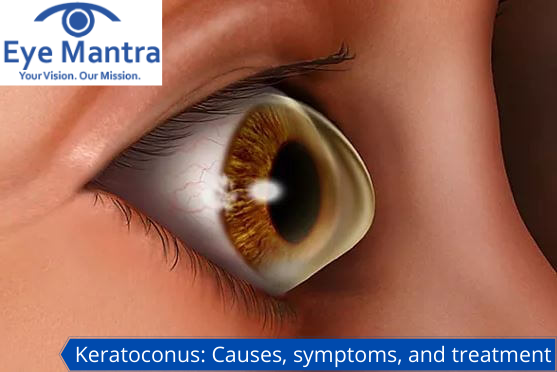 Keratoconus Causes, symptoms, and treatment