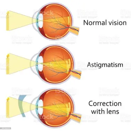Lenses for correcting cylinder Defect