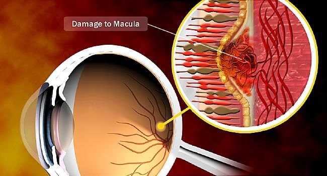 Macular Degeneration