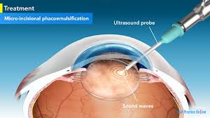 Micro Phaco Cataract Surgery