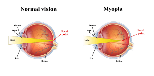 Nearsightedness (Myopia)