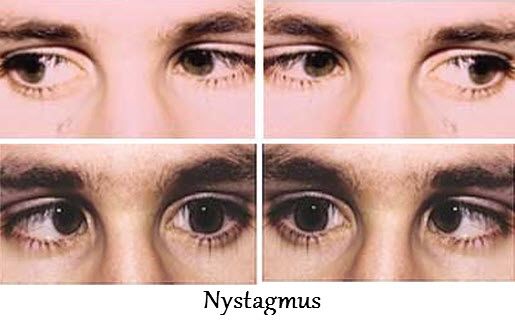 Nystagmus Causes Symptoms And Treatment Types Of Nystagmus