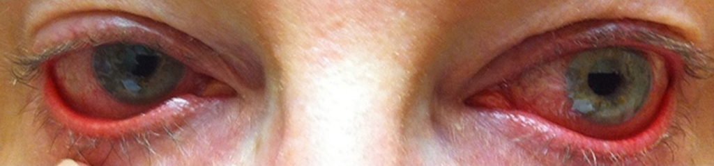 Ocular rosacea