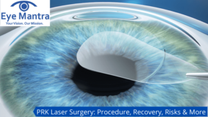 PRK Laser Surgery