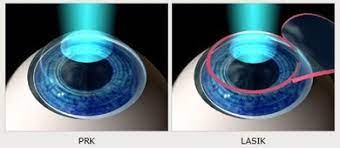 PRK Versus Lasik Surgery