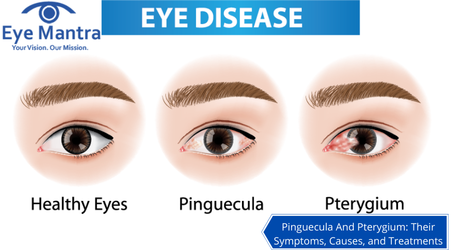 Pinguecula And Pterygium Their Symptoms, Causes, and Treatments