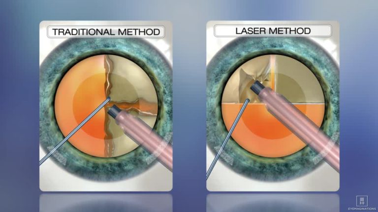 Femtosecond Laser-Assisted Cataract Surgery: A Review | Its Benefits