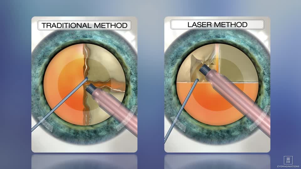 Procedure Of Femtosecond Cataract Surgery
