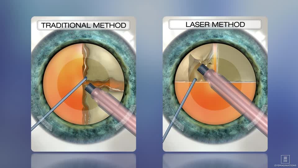 Femtosecond Laser Assisted Cataract Surgery A Review Its Benefits