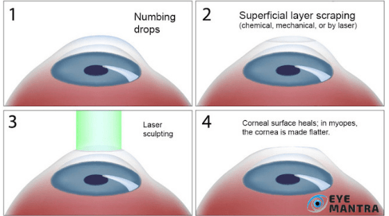 Process Of PRK Laser Surgery