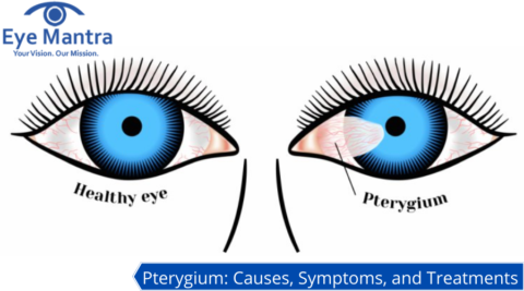 Pterygium Remove Naturally | Surfer's Eye | Causes And Treatment