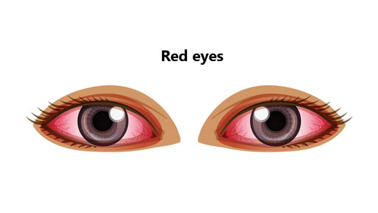 Red Eyes (Pinkeye)
