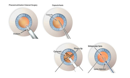 Regular Phaco Surgery for Cataract