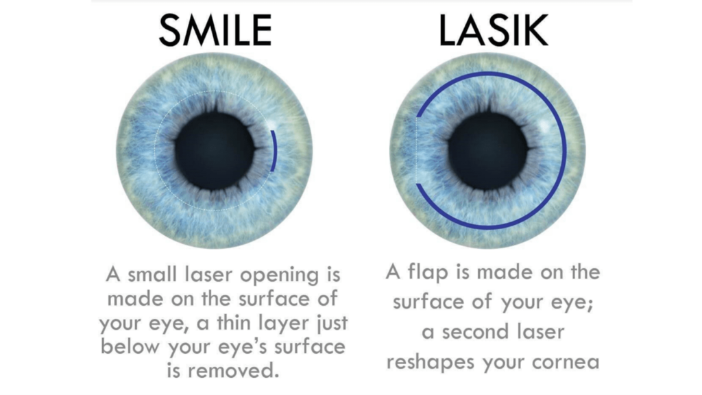 SMILE laser eye surgery