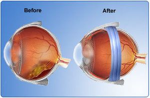 Scleral Buckle