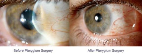 Pinguecula And Pterygium- Eye Disease | Symptoms And Treatment