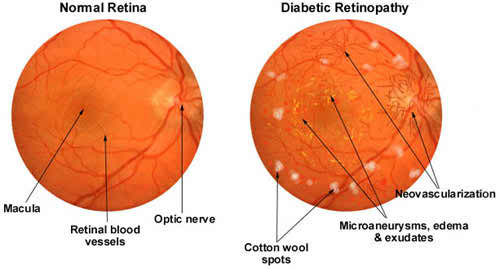 Symptoms Of Diabetic Retinopathy