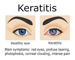 Symptoms of Keratitis
