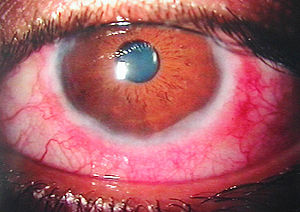 Vernal keratoconjunctivitis