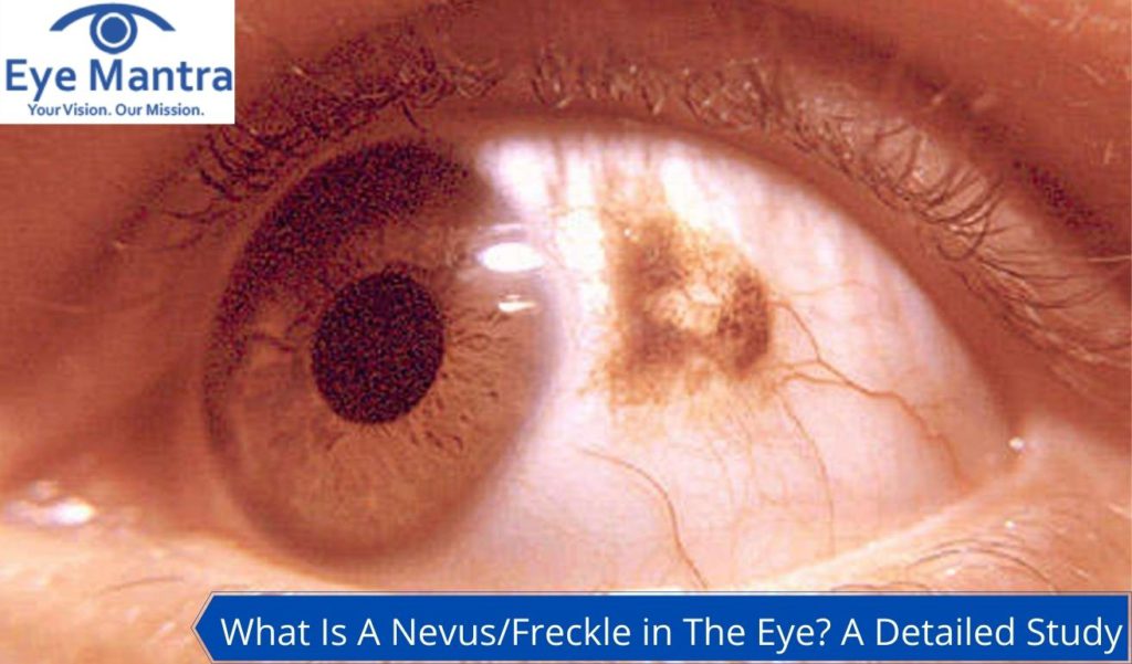 Nevus/Freckle in The Eye