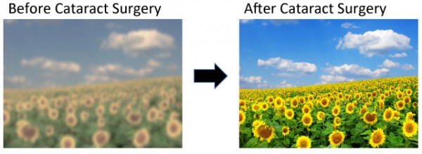 cataract surgery before and after