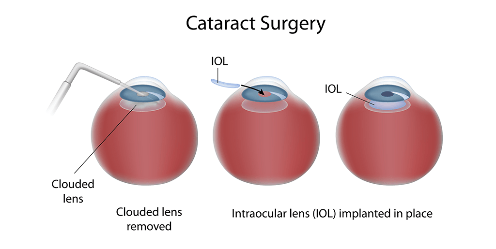 catract operation
