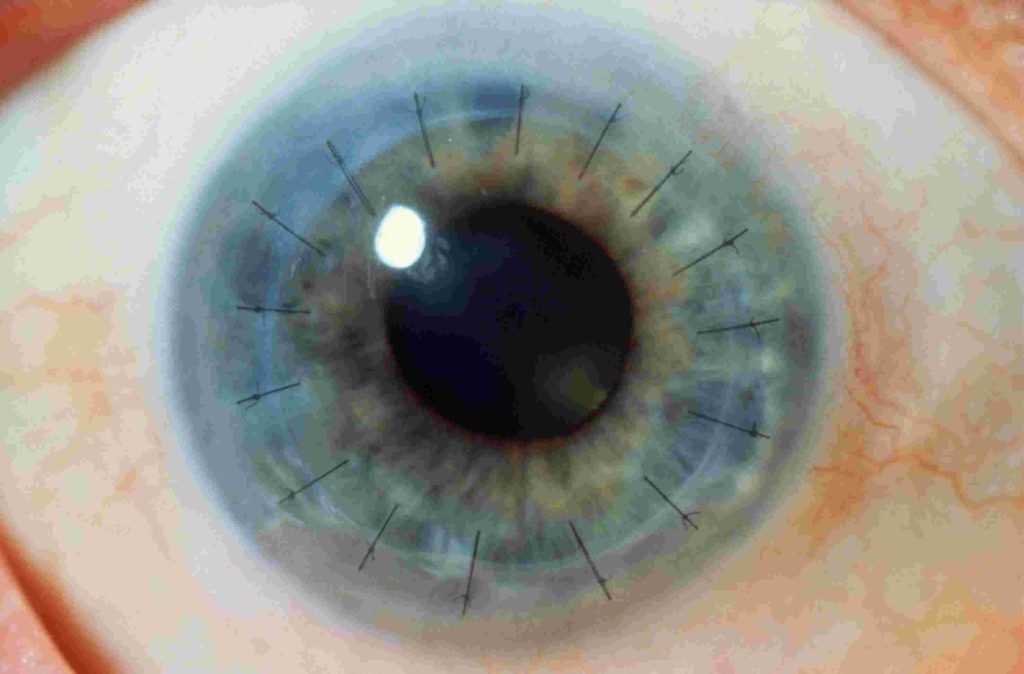 corneal transplant