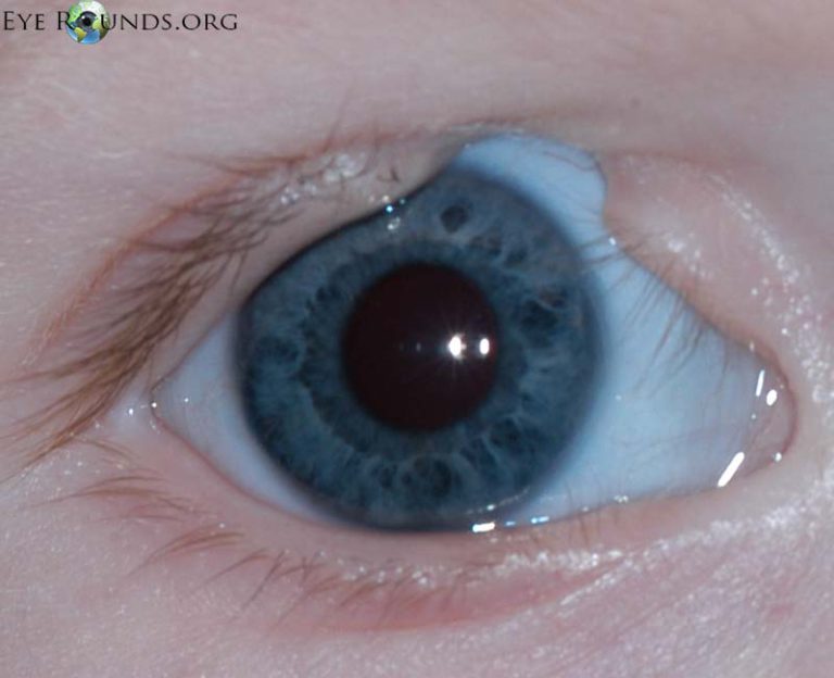 Coloboma- A Complete Guide | Eyelid Coloboma Surgery