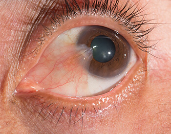 pterygium