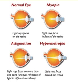 Astigmatism